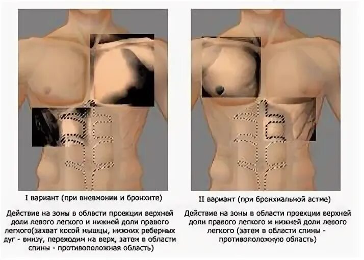 Интенсивный массаж асимметричных зон грудной клетки