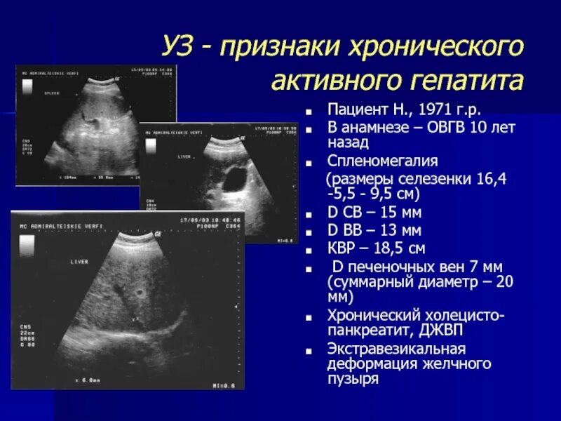 Диффузный гепатит. Ультразвуковые критерии цирроза печени. УЗИ критерии хронического гепатита. Ультразвуковое исследование при патологии печени. Острый гепатит УЗИ картина.