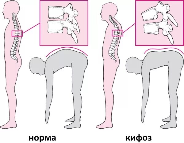 Кифоз грудного отдела степени. Кифоз грудного отдела позвоночника упражнения. усилен кифоз грудного отдела. кифоз позвоночника 4 степени. грудной кифоз уплощен что это.