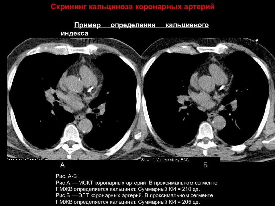 Кальциноз коронарных артерий на кт. Кальциноз митрального клапана на кт. МСКТ скрининг коронарного кальция. Кальциноз коронарных сосудов кт.