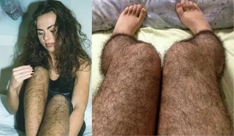 Волосатые ноги у женщин