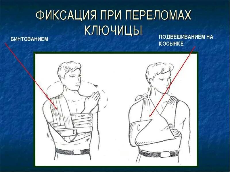 При переломе ключицы оказывают первую помощь. Косыночная повязка на ключицу. повязка шарашенидзе при переломе ключицы. повязка дезо при переломе ключицы у ребенка 3 года. перелом ключицы наложение шины.