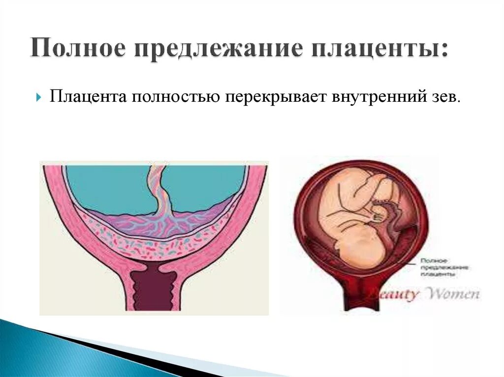 Краевое предлежание форум. Плацента перекрывает внутренний зев 13 недель беременности. предлежание плаценты внутренний зев. предлежание плаценты с врастанием. центральное предлежание плаценты узи.