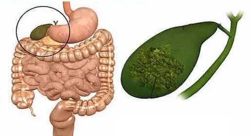 Сгустки в желчном пузыре. Билиарного сладжа в желчном пузыре. Сладжа в желчном пузыре что это.