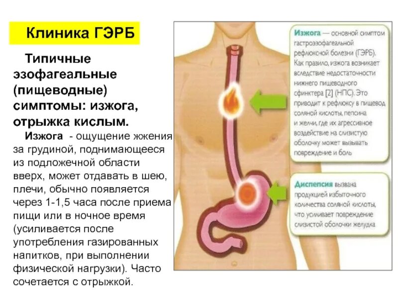 Кашель пищевода