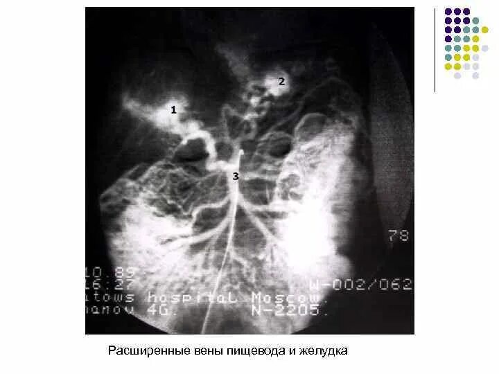 Варикоз вен пищевода рентген. Варикозно расширенные вены пищевода рентген. Расширенные вены пищевода рентген. Расширенные вены пищевода патология?.