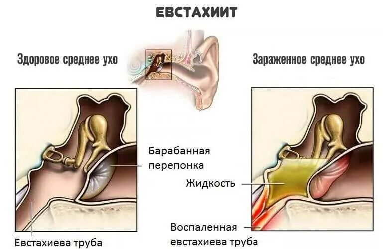 Хронический тубоотит