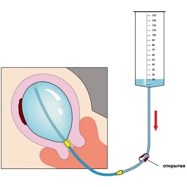 Катетер для беременных. Управляемая баллонная тампонада матки. Баллон Жуковского катетер маточный баллонный. Баллонная тампонада матки Жуковского. Управляемая баллонная тампонада Жуковского.