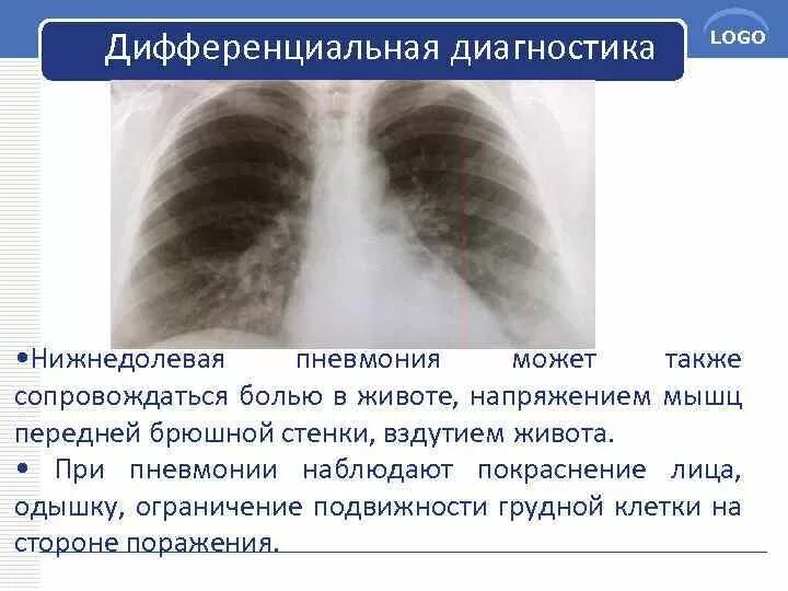 Локализация пневмонии в легких. Легкие болят при пневмонии. Болит лёгкое при пневмонии. Правосторонняя нижнедолевая пневмония дифференциальная диагностика.