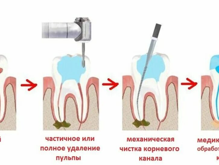 Сколько ходят с лекарством в зубе