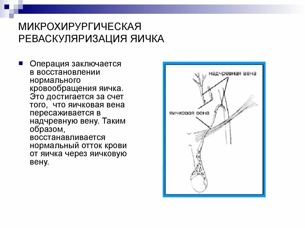 Расширение вен канатика. Варикоцеле – расширение вен семенного канатика. Микрохирургическая реваскуляризация яичка. Реваскуляризация яичковой вены. Кровоснабжение яичка схема.