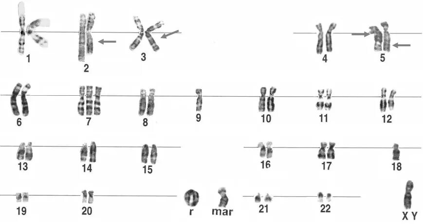 Кольцевая хромосома 2. Кольцевая хромосома в кариотипе. Механизм формирования кольцевой хромосомы. Схема хромосомы человека. Кольцевая хромосома у человека.