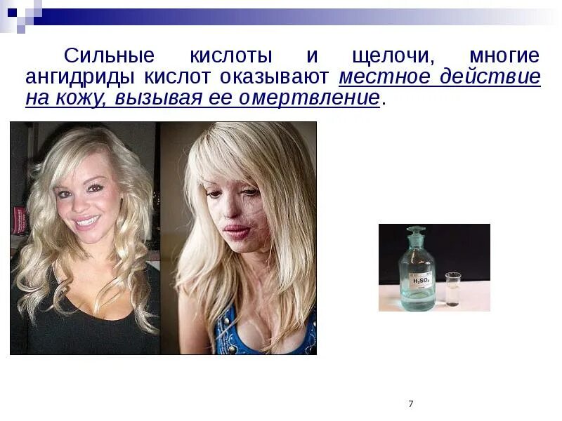Что происходит после кислоты. Кислоты и щелочи. отравление серной кислотой.