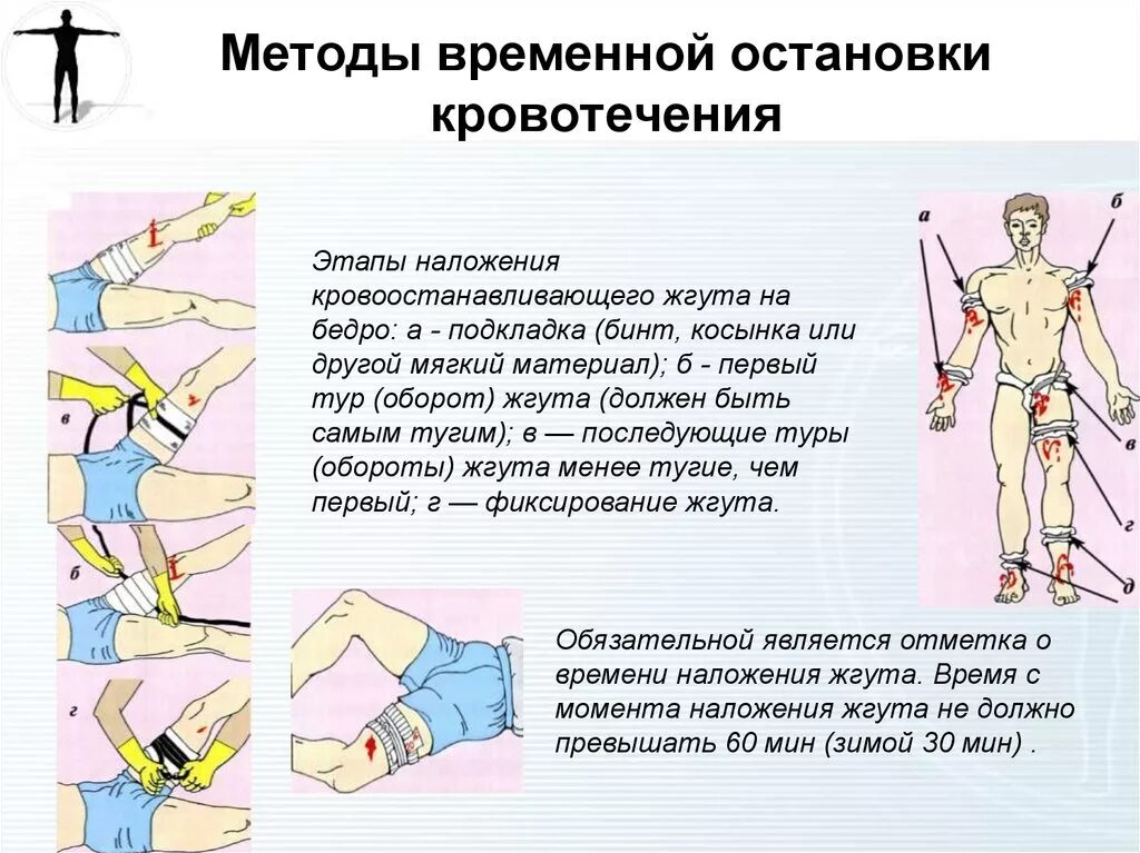 Метод наложения жгута при кровотечении. Порядок наложения кровоостанавливающего жгута на конечность. Наложение жгута при артериальном кровотечении алгоритм действий. Методы остановки кровотечений. Временная остановка кровотечения.. Повреждение мелких артерий кистей и стоп