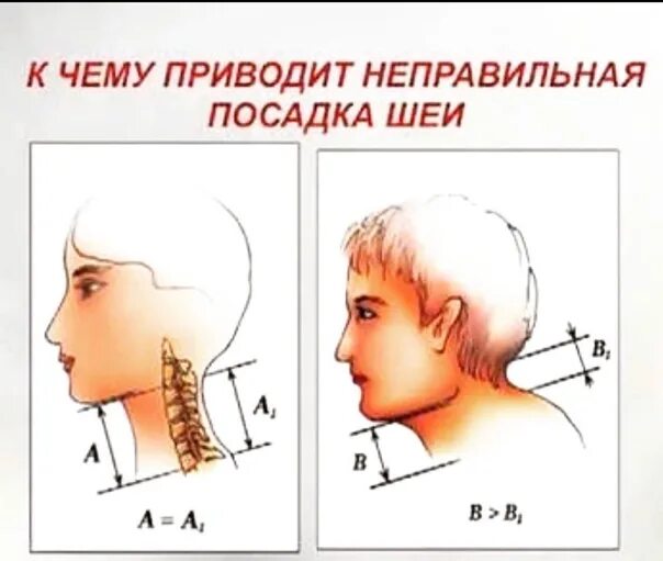 Неправильная посадка шеи. Правильное положение головы. Ревитоника упражнения для шеи и осанки. Правильное положение шеи и головы.