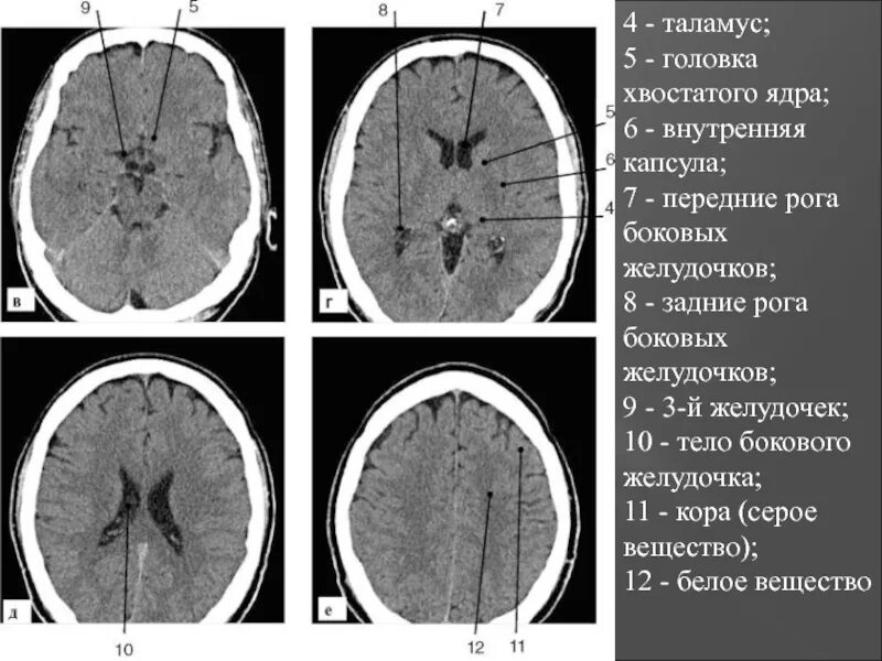 Расширение боковых рогов