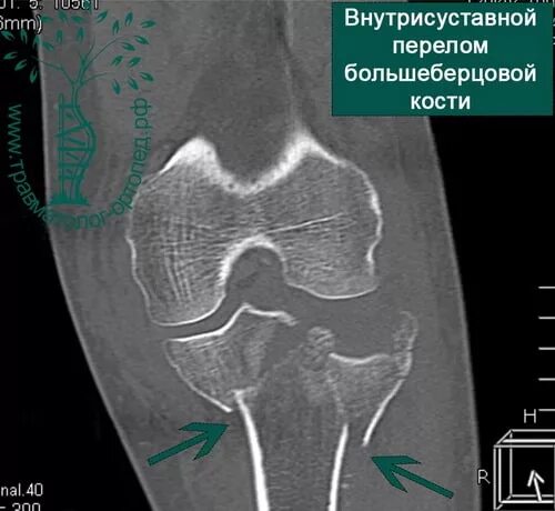 Импрессионный перелом коленного сустава кт. Перелом мыщелка большеберцовой кости кт. Межмыщелковый перелом большеберцовой кости. Чрезмыщелковый перелом большеберцовой кости. Перелом латерального мыщелка большеберцовой кости.