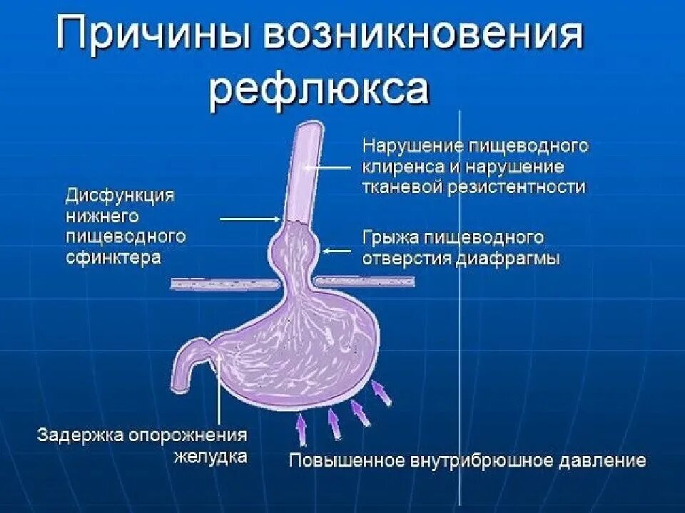 Просвет пищевода. Желудочно пищеводный рефлюкс рентген. Эзофагеальные симптомы ГЭРБ. Гастроэзофагеальной рефлюксной болезни. Гастроэзофагеальная рефлюксная.