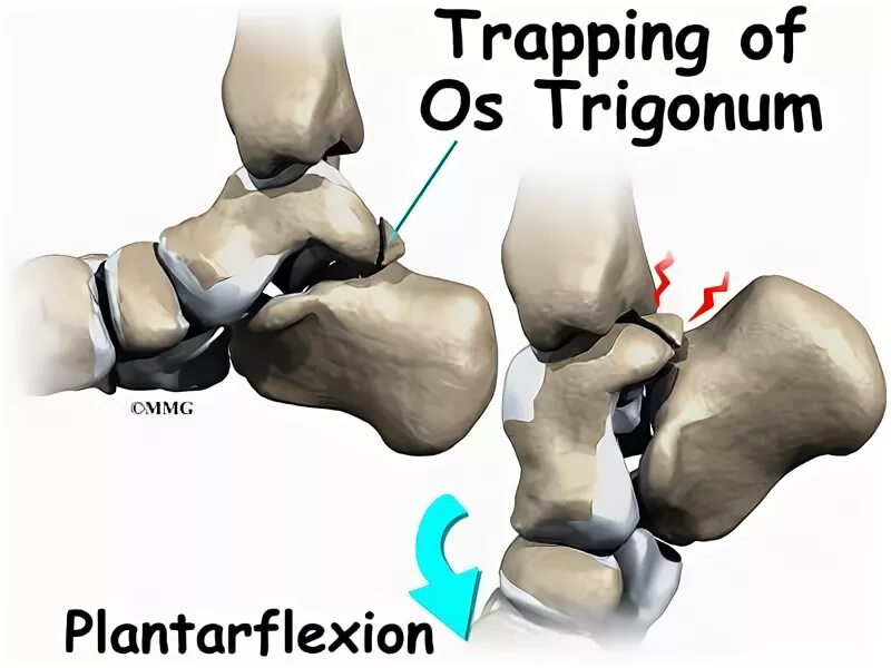 Импиджмент синдром голеностопного сустава. Os Trigonum таранной кости. Задний импинджмент голеностопного сустава. Импинджмент таранной кости.