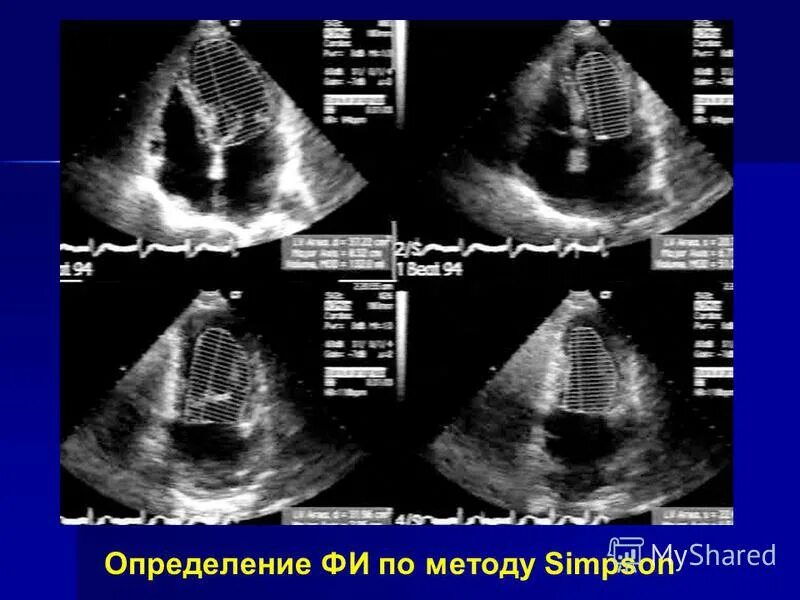 фв эхокардиография. эхокардиография фв. фракция выброса левого желудочка норма. эхокг фракция выброса по тейхольцу. узи сердца фракция выброса норма.
