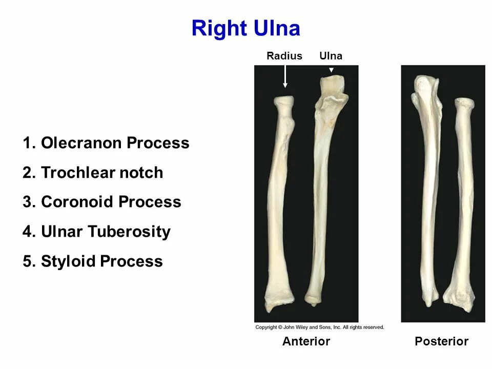 Olecranon латынь. Olecranon ulnae. coronoid process of ulna. trochlear notch. olecranon process.
