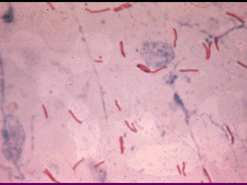Палочка Коха микроскопия. Палочки – микобактерия туберкулеза. Палочка Коха микрофотография. Микобактерии туберкулеза микробиология.