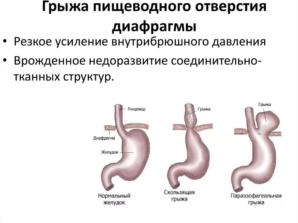 Диафрагмальный пищевода