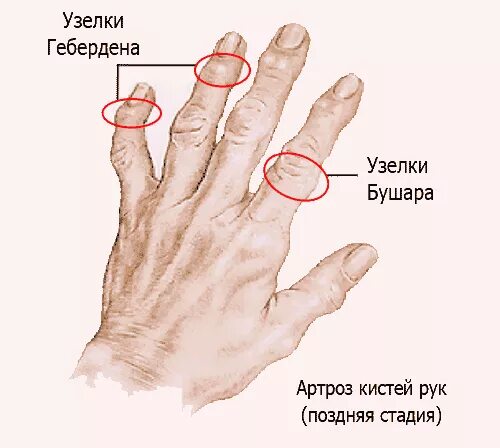 Почему на суставах пальцев