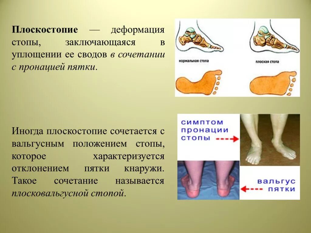 Чем может быть вызвано плоскостопие у человека. Возникновения плоскостопия. Профилактика плоскостопия. Нарушение плоскостопия. Причины развития плоскостопия.