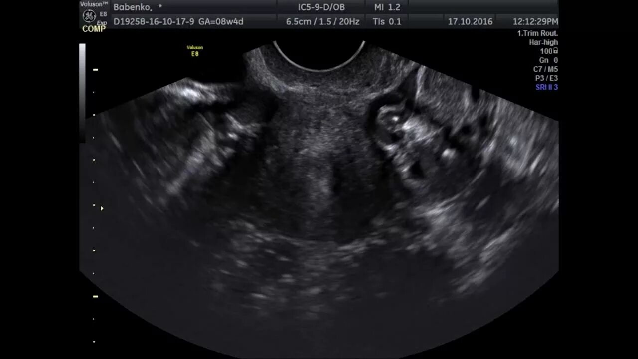 4 5 Недель беременности УЗИ внематочная. УЗИ 5 недель беременности внематочная беременность. Внематочная беременность на УЗИ фото. Внематочная Трубная беременность 5 недель УЗИ.