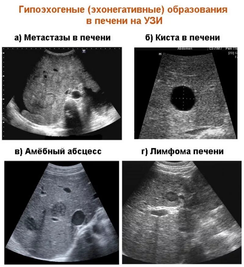 Образование печени что значит. Ультразвуковое исследование печени. Нормальная печень.. КВР печени УЗИ. Гипоэхогенные образования в печени метастазы. Злокачественные образования печени на УЗИ.