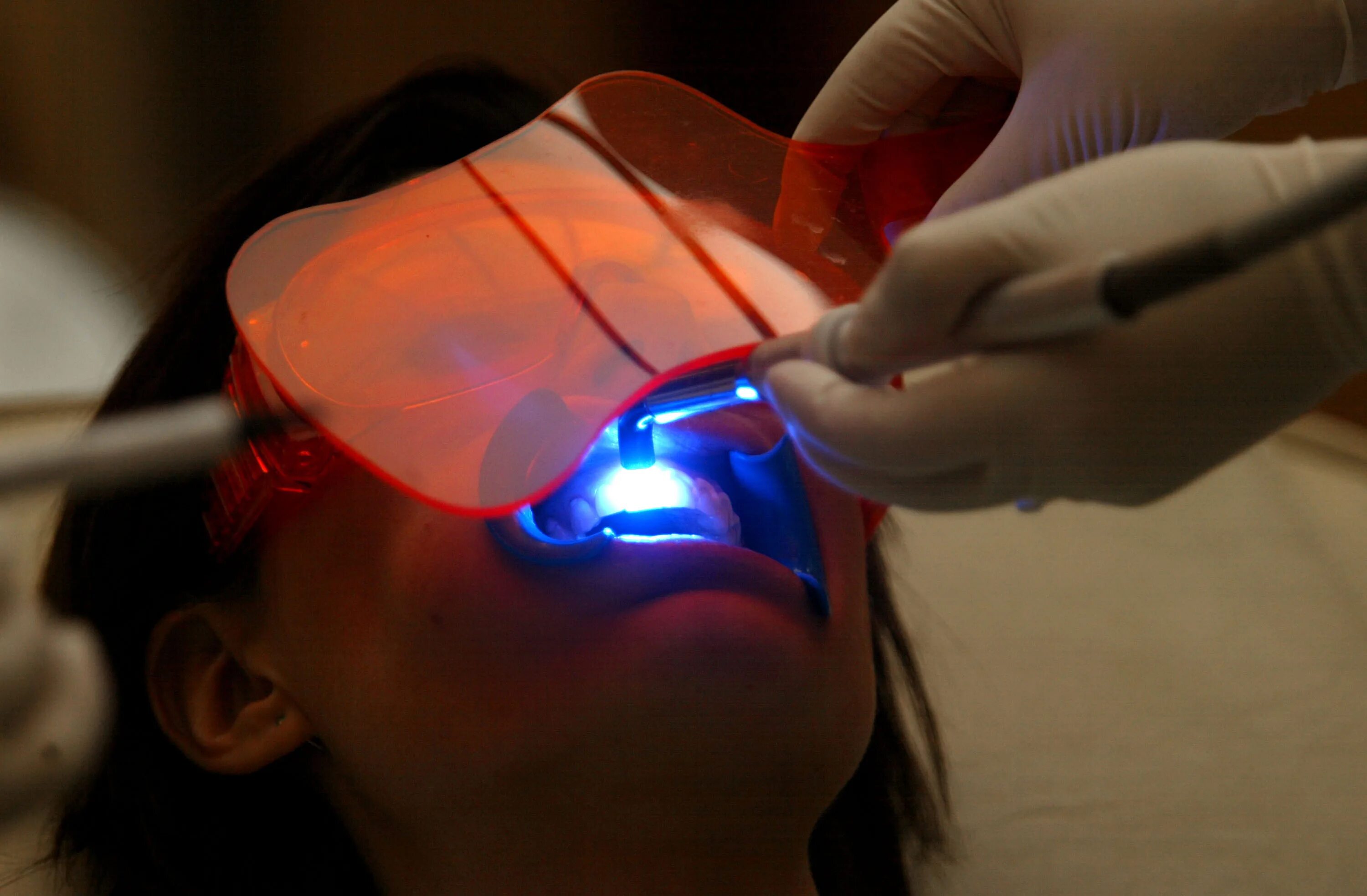 Лазерное отбеливание зубов. Лазерное излучение в медицине.