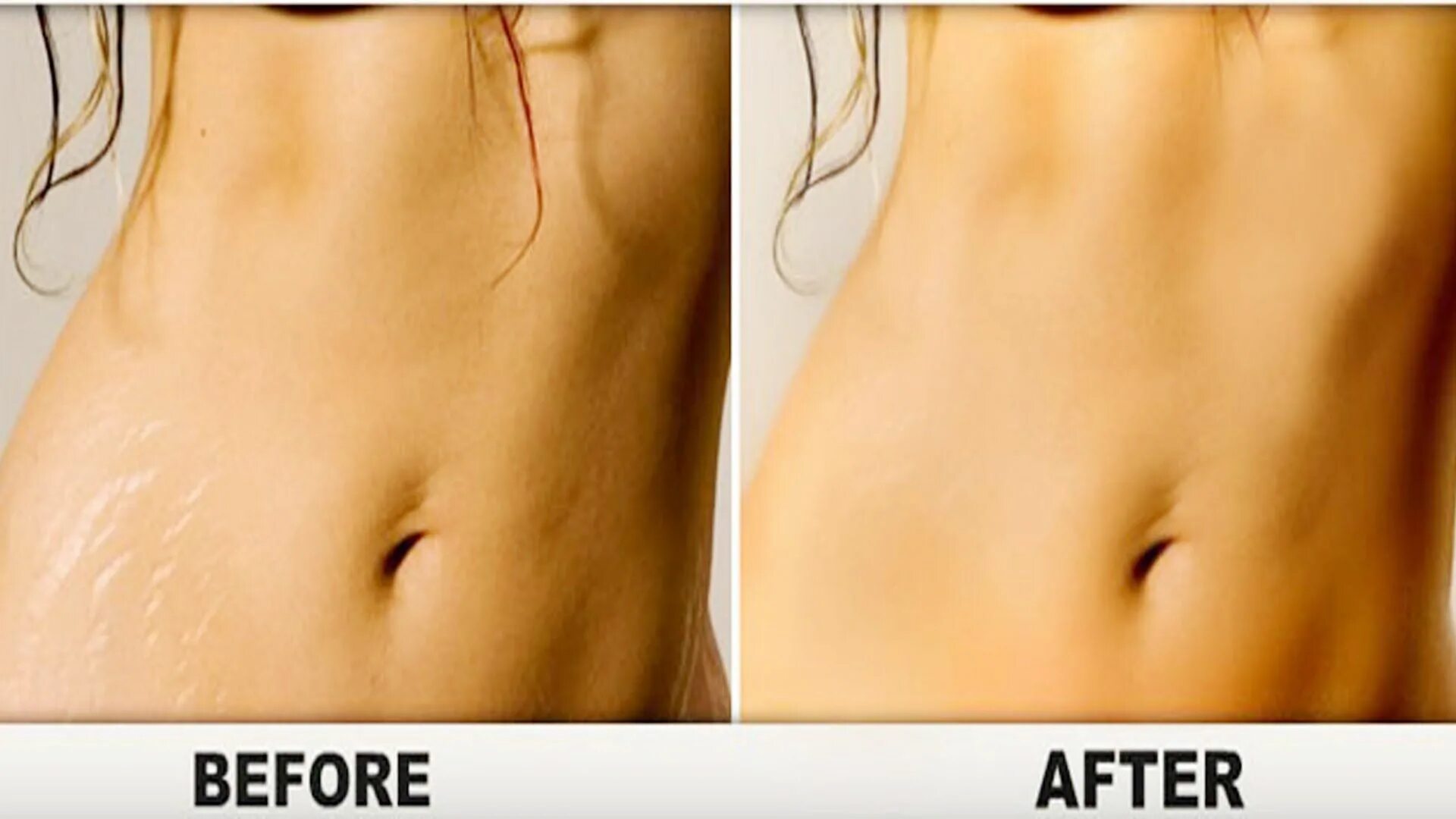 Растяжки stretch marks. Лазерная шлифовка растяжек на животе. растяжки на теле до после.