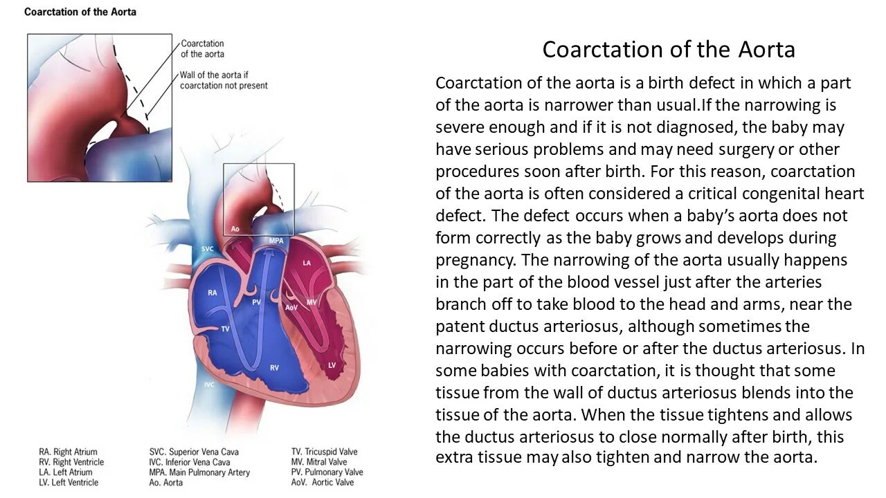 Синдром дауна пороки сердца. Синдром дауна какие пороки сердца. aortal coarctation radiopedia.