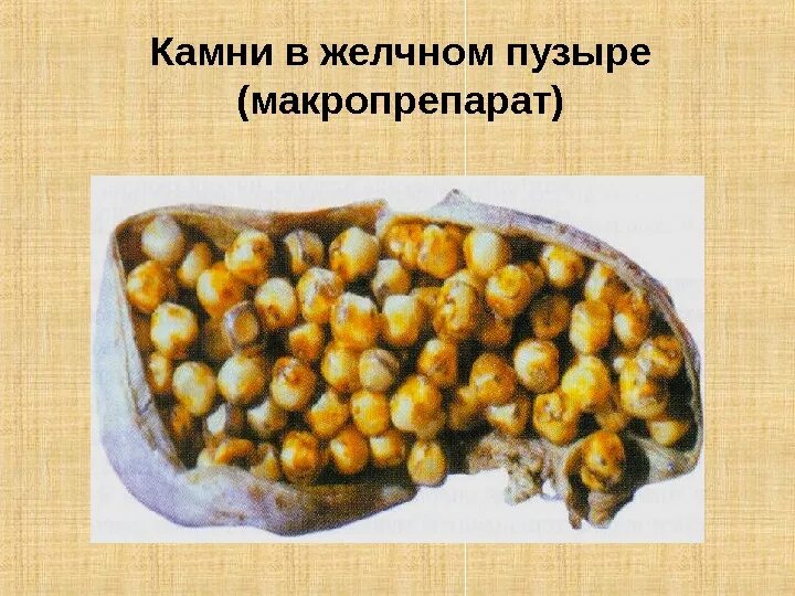 Камушек желчный пузырь