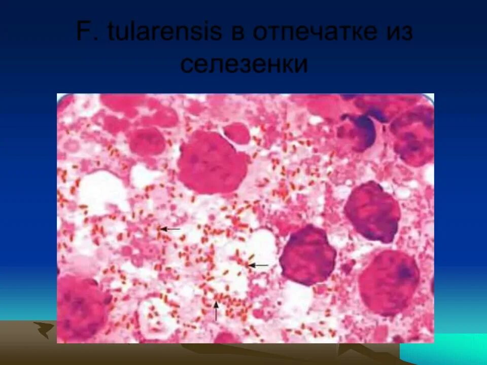 Возбудитель francisella tularensis. Туляремия переносчики инфекции. Механизм заражения туляремией. Чума клинические формы. Туляремия возбудитель francisella tularensis.