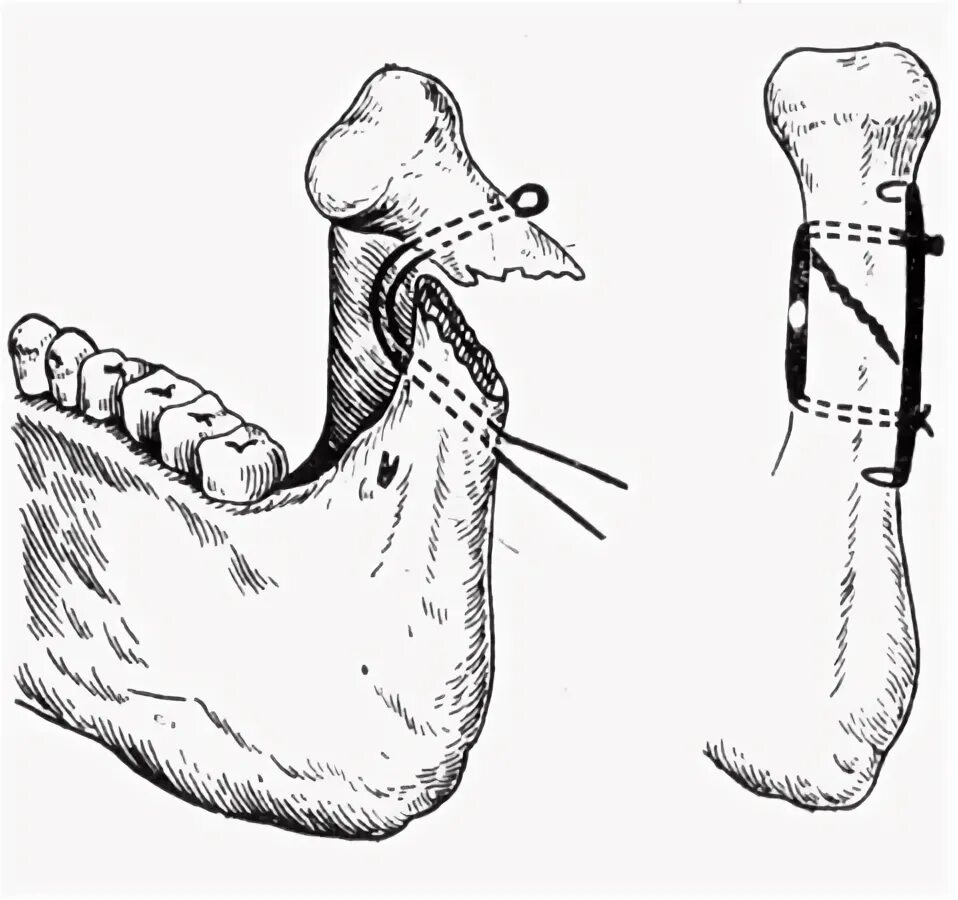 Перелом мыщелкового отростка челюсти. Перелом мыщелкового отростка нижней челюсти. Закрытый перелом мыщелкового отростка нижней челюсти. Перелом суставного отростка челюсти.