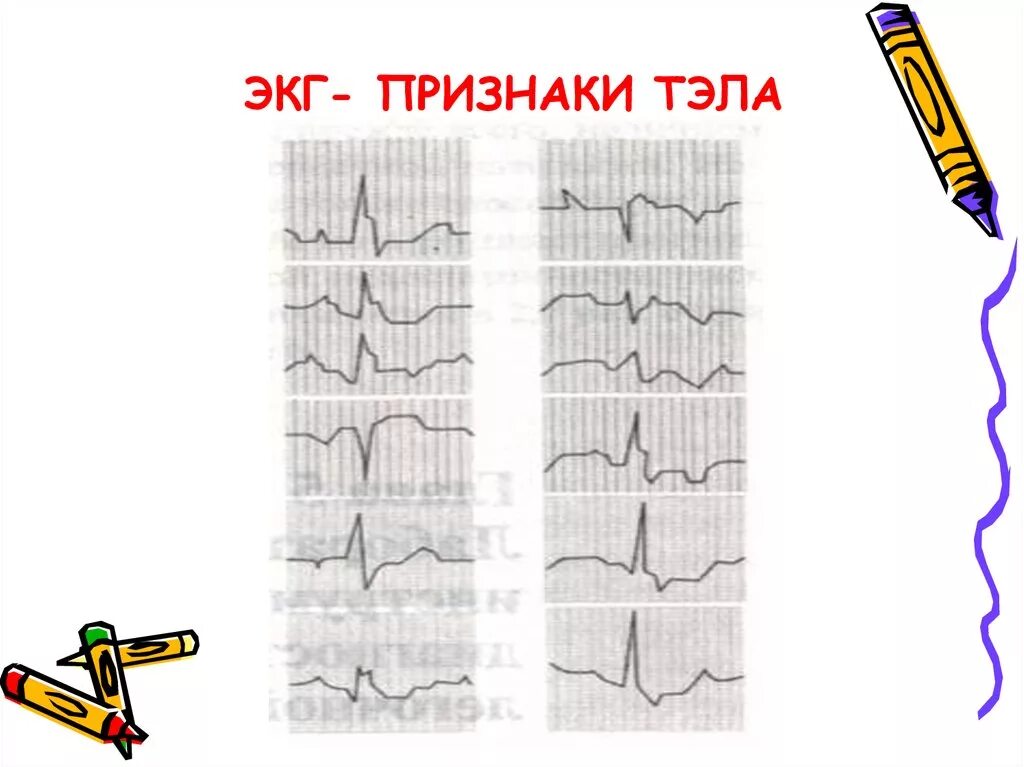 Тромбоэмболия легочной артерии экг. Тэла на ЭКГ. Признаки Тэла на ЭКГ. Тела на ЭКГ. ЭКГ признаки Тэла на ЭКГ.