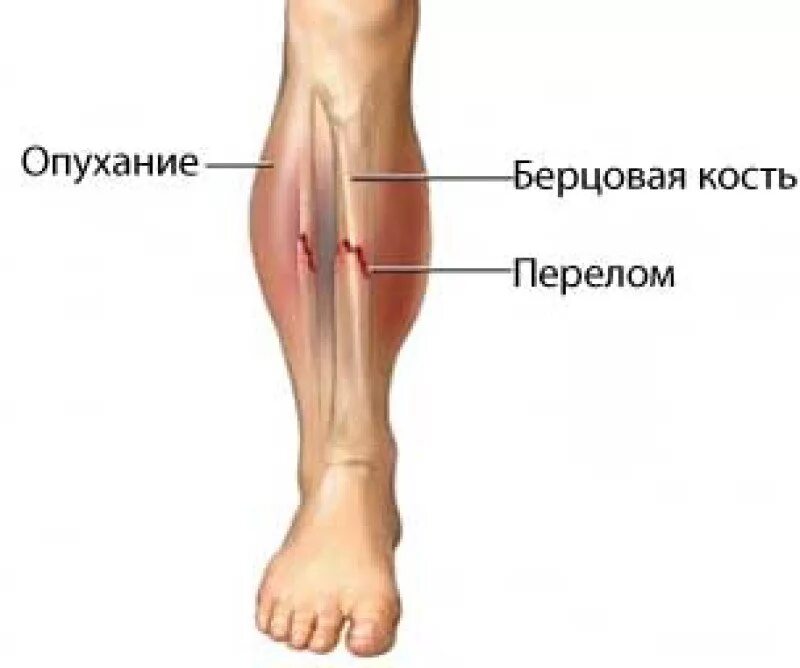 Болит большая берцовая. Большеберцовая кость голени. Малоберцовая кость голени. Перелом малой берцовой кости. Перелом голени берцовая кость.