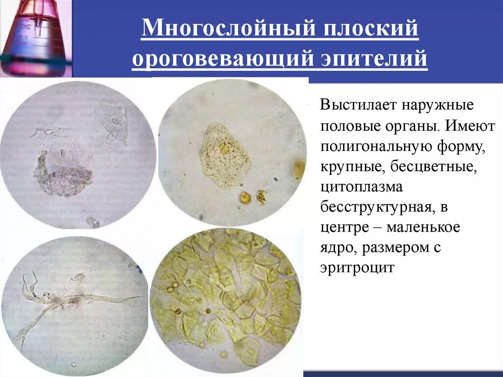 Повышенный эпителий в моче у мужчин. Микроскопия осадка мочи плоский эпителий. Микроскопия мочи эпителий плоский. Многослойный плоский неороговевающий эпителий в моче. Плоский эпителий микроскопия мочевого осадка.