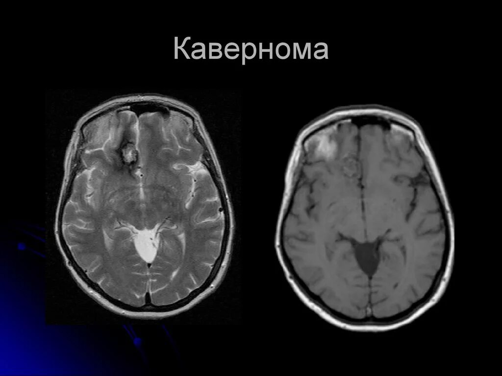 Ангиома правой лобной доли. Кавернозная ангиома мрт. Кавернома ствола головного мозга кт.