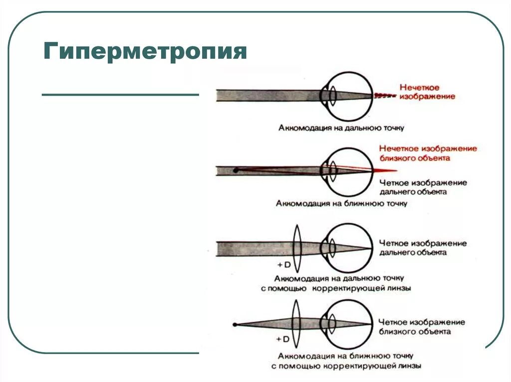 Гиперметропия средней степени глаза. Гиперметропия средней степени. Диагноз глаз гиперметропия. Гиперметропия слабой степени обоих глаз. Степени гиперметропии у детей.