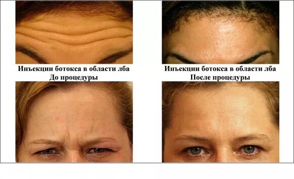 Можно ли делать массаж после ботокса. Ботокс птоз верхнего века. нависание века после ботокса. опустились веки после ботокса.
