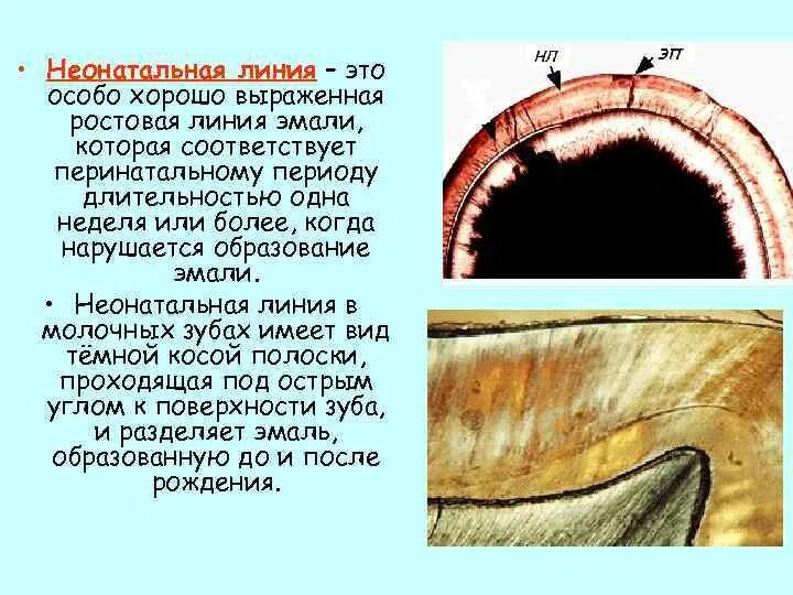 Линии эмали. Линии эмали. Линии ретциуса. Строение эмали гунтера шрегера. Линии шрегера и ретциуса.