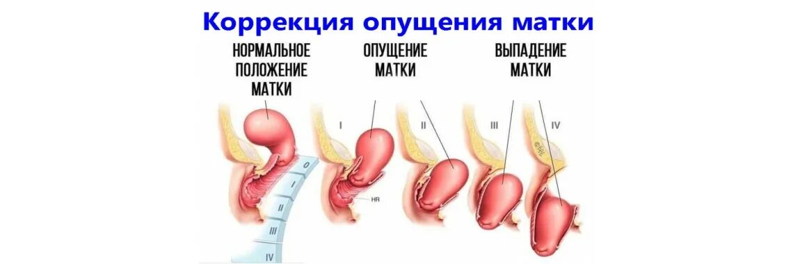 Как лечить опущение матки. Как лечить опущение матки