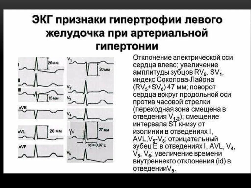 Гипертрофия миокарда лж на ЭКГ. Критерии гипертрофии левого желудочка на ЭКГ. Гипертрофия желудочков на ЭКГ. Критерии гипертрофии миокарда левого желудочка ЭКГ.