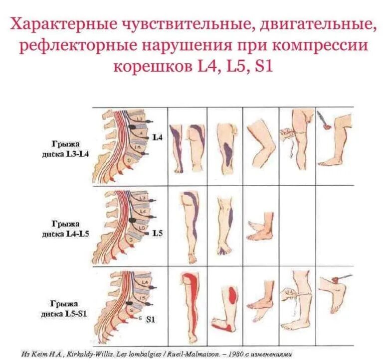 Радикулопатия с6. Синдром корешка l4. Компрессии корешка l5 или s1. Компрессия Корешков позвоночника l5 s1. Корешковый l4.