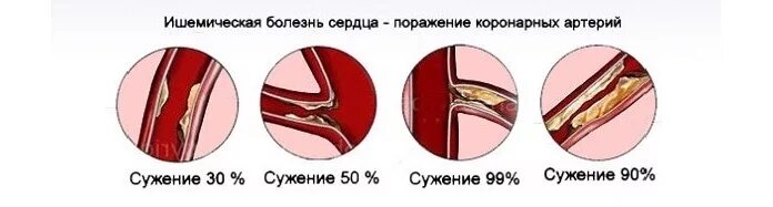 Процент стеноза сосудов. Классификация стенозов коронарных артерий. Степени стеноза коронарных артерий. Степени сужения коронарных артерий. Степени стеноза коронарных артерий в процентах.