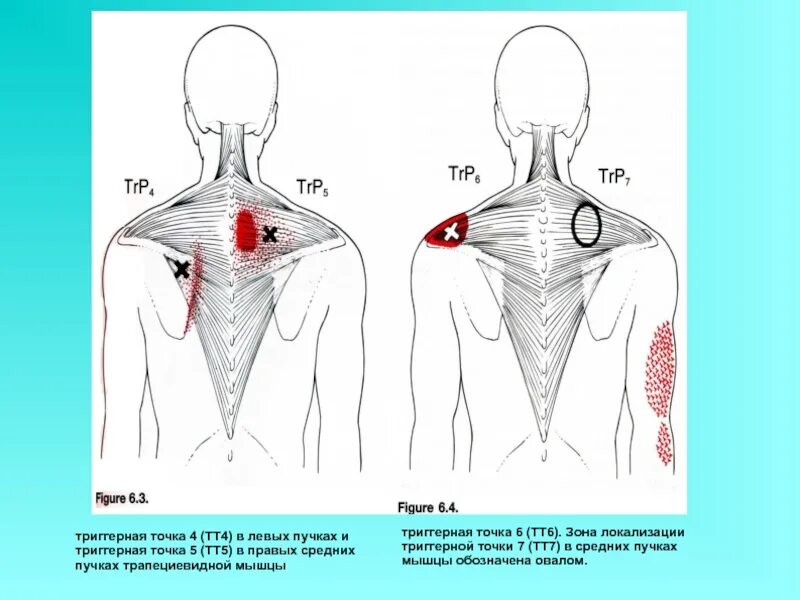 Задняя зубчатая мышца триггерные точки. Триггерные точки в мышцах спины. Задняя зубчатая мышца триггерные точки. Подлопаточная мышца триггерные точки. Мышца поднимающая лопатку триггер.