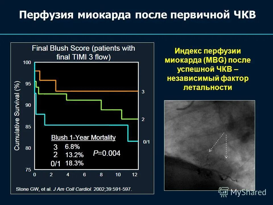 чкв при инфаркте миокарда